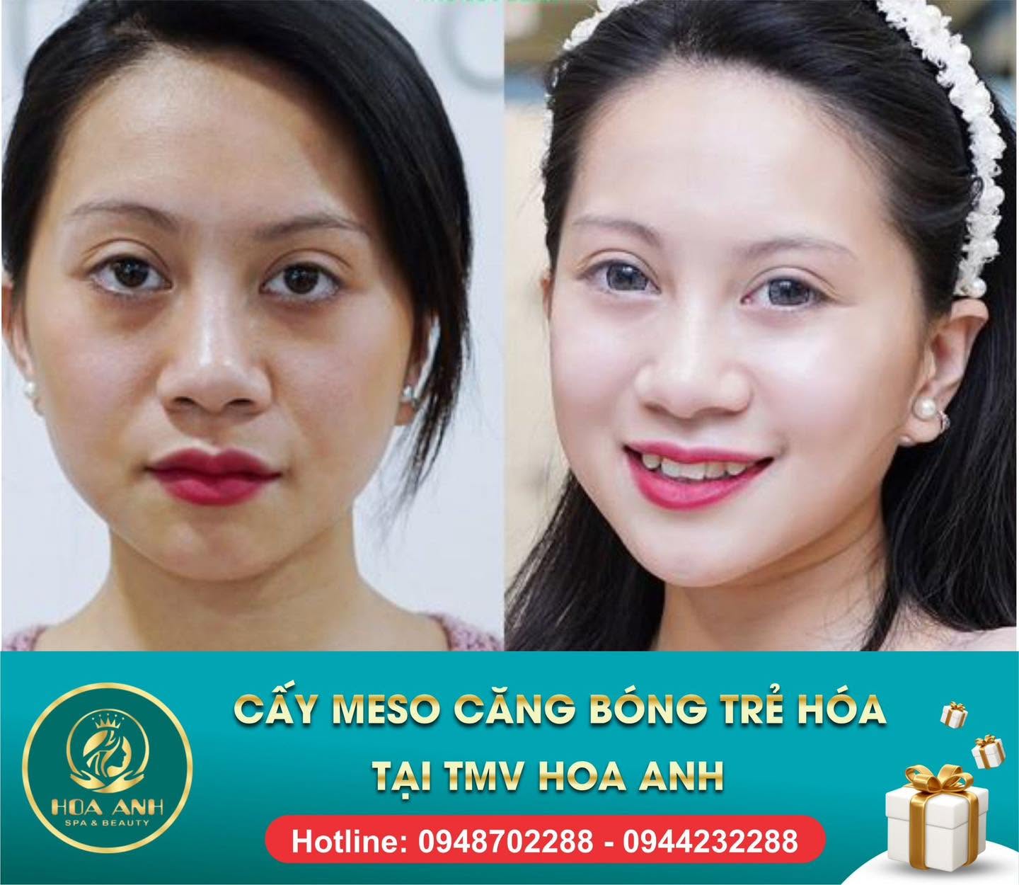 Trước và sau tiêm Meso trẻ hóa da tại Hoa Anh